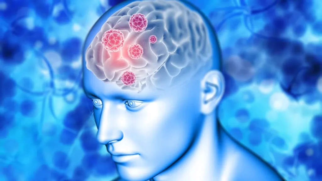 brain-tumour-1-1753077708