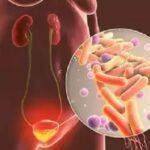 UTI-Infection